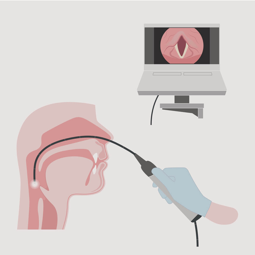 Illustration der FEES-Methode zur visuellen Beurteilung des Schluckvorgangs bei logopädischer Therapie.
